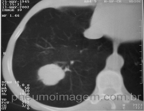 EUA DISCUTEM COMO FAZER E QUEM VAI PAGAR OS CUSTOS DO RASTREIO DO C�NCER DE PULM�O